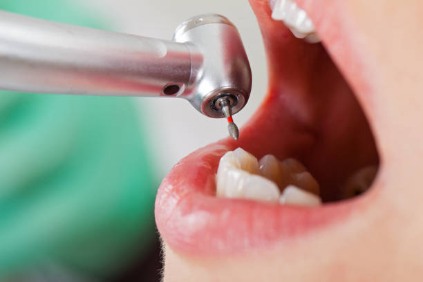 Best Broken or Chipped Tooth Repair in Salado, TX